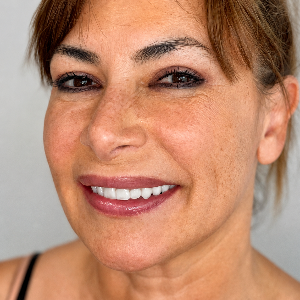 Before and after porcelain veneers and smile design at Hera Clinic